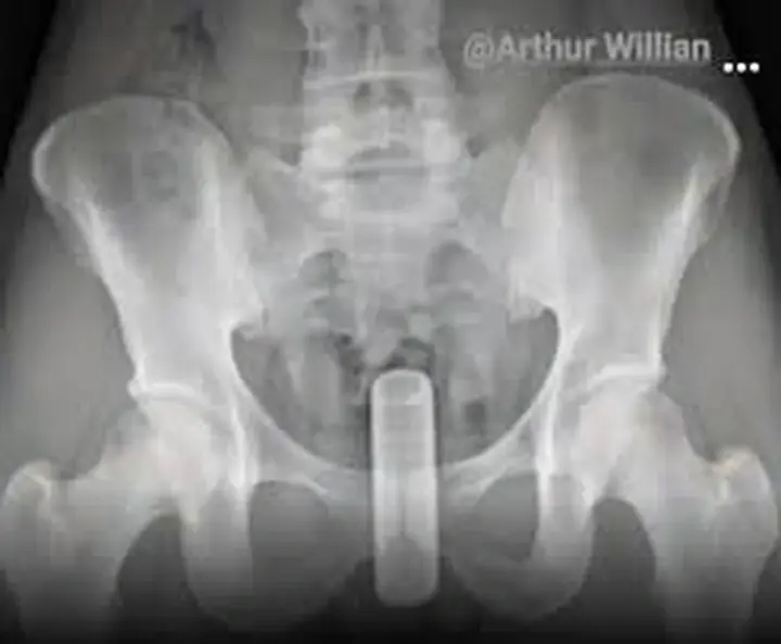 Homem usa cabo de vassoura de ferro para coçar as costas, perfura o próprio corpo e precisa de cirurgia em Alagoas