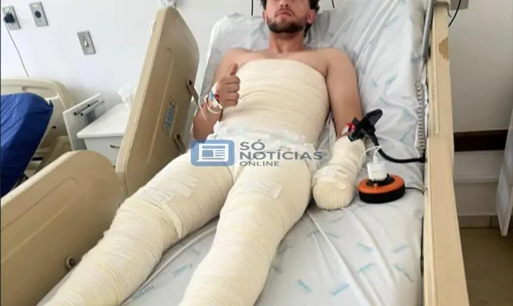 Jovem sofre queimaduras graves após amigo incendiar barraca em confraternização em Lagamar; família questiona investigação